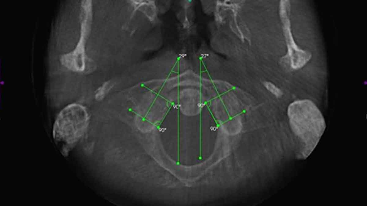 AXIAL VIEW OF FORAMEN MAGNUM AND ATLAS