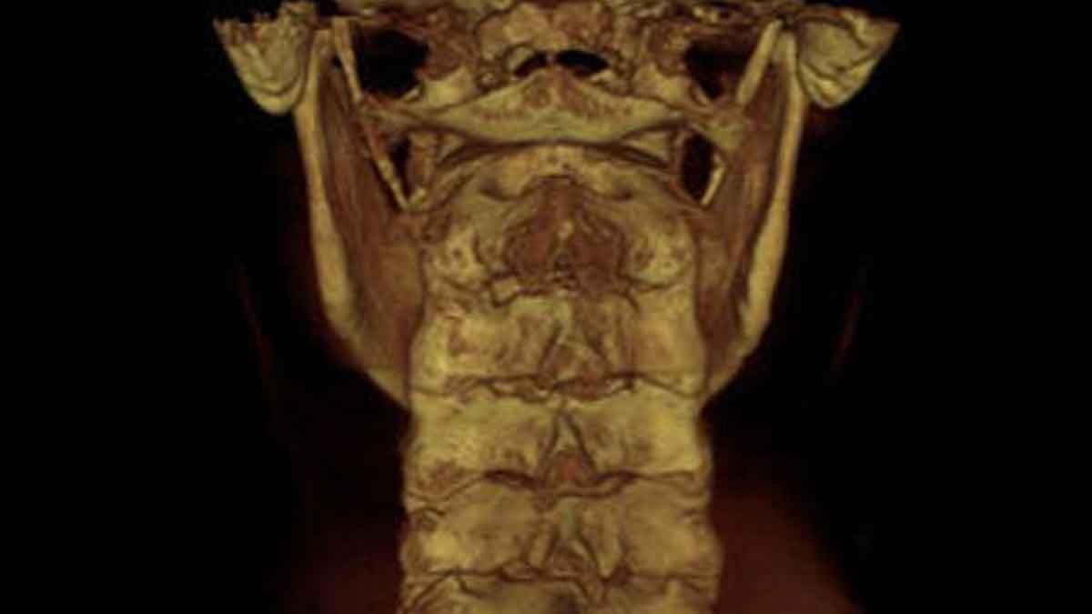 SAGITTAL VIEW OF UPPER CERVICAL SPINE
